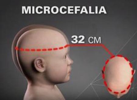 microcefaleia.jpg